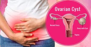 Read more about the article Several Points where the Ovarian Cysts can be Understood